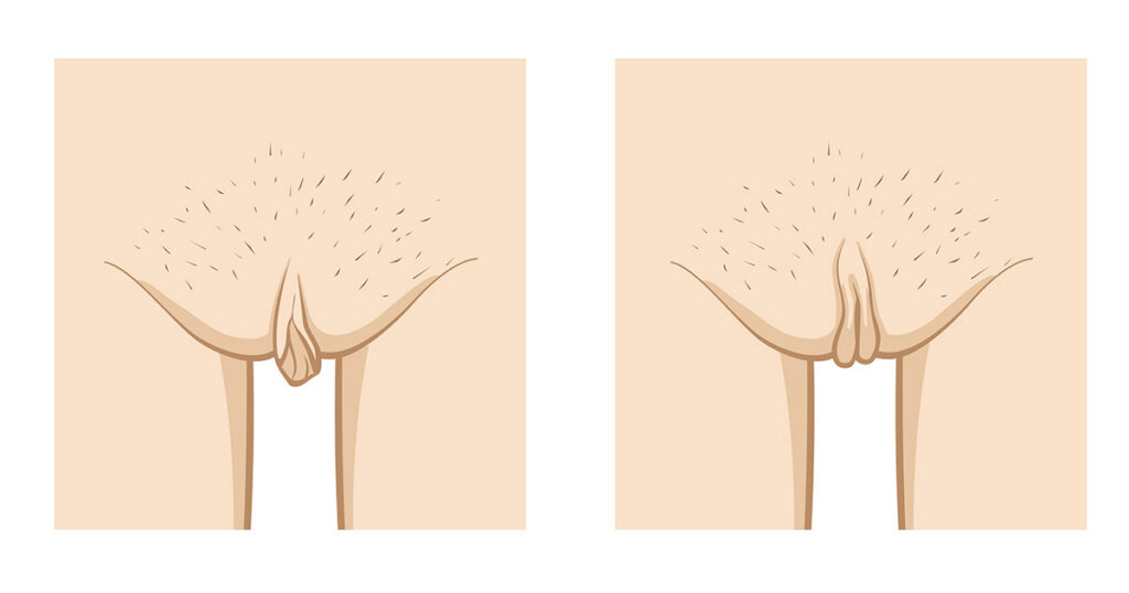 What Causes Labia Minora to Stick Out