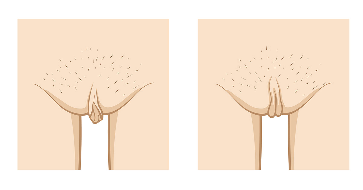 What Causes Labia Minora to Stick Out