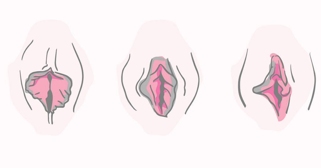 What Is Labia Hypertrophy