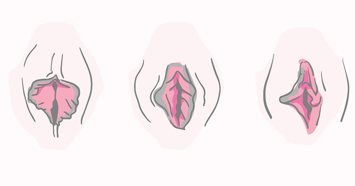 Qué es la hipertrofia de labios mayores