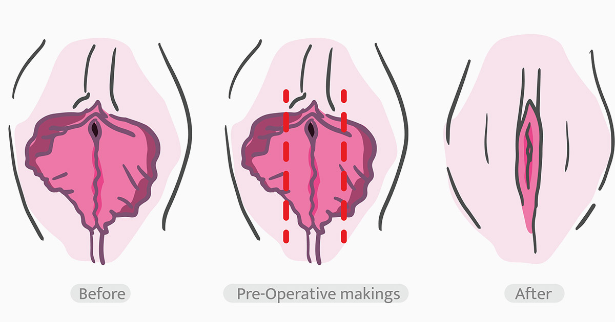 What Is Labiaplasty and Why Is It Performed