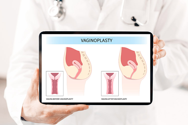 Vaginoplasty for vaginal laxity