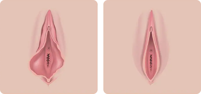 Before and After Labiaplasty Photos