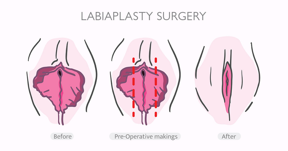 Is Labiaplasty Permanent