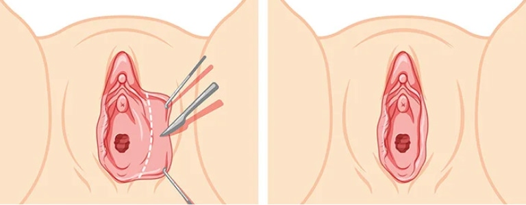 Labiaplasty Trim Technique NYC