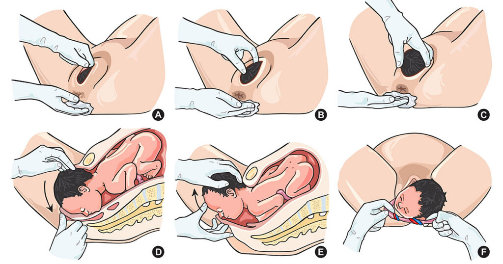 How Long Do Vaginoplasty Results Last