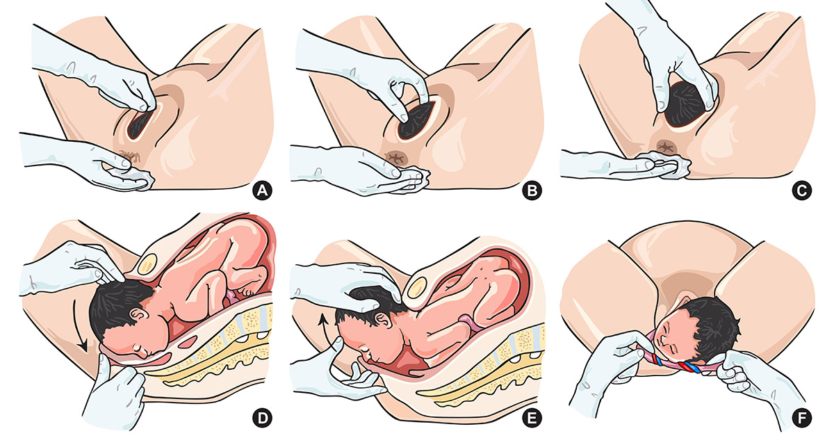 How Long Do Vaginoplasty Results Last