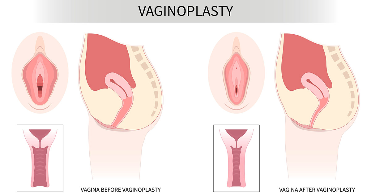 How Long Do Vaginoplasty Results Typically Last