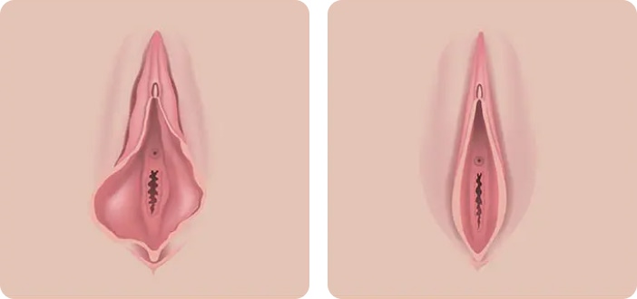 Fotos de antes y después de la vaginoplastia NYC