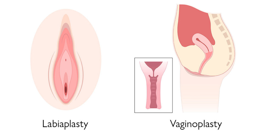 Are Labiaplasty and Vaginoplasty Very Similar