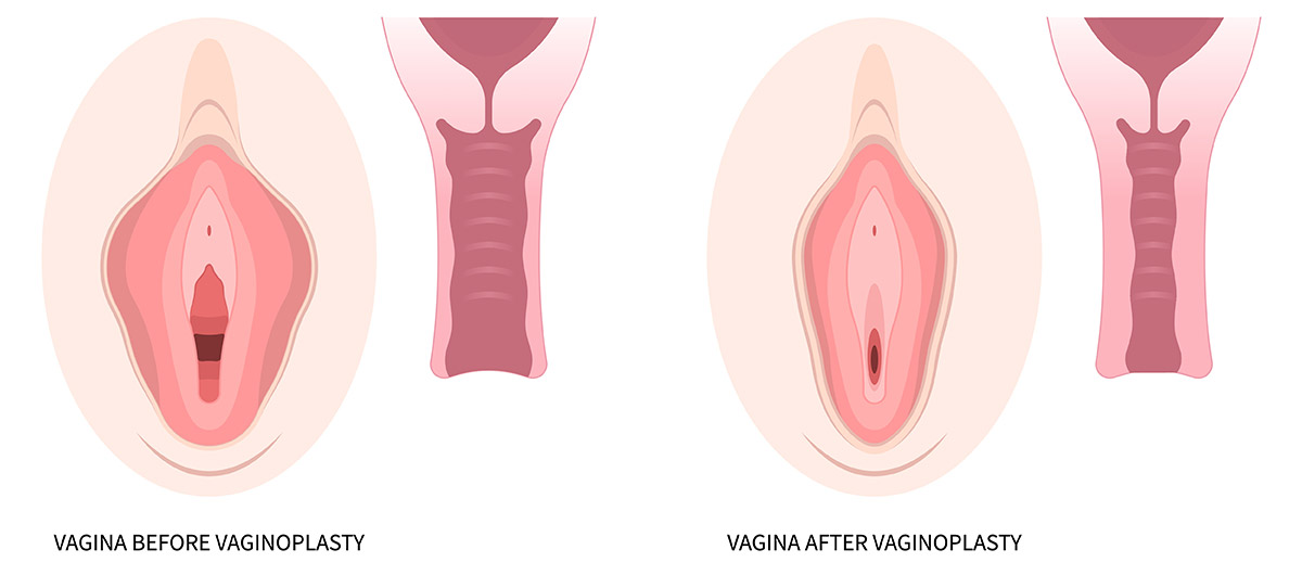 Vaginoplasty NYC