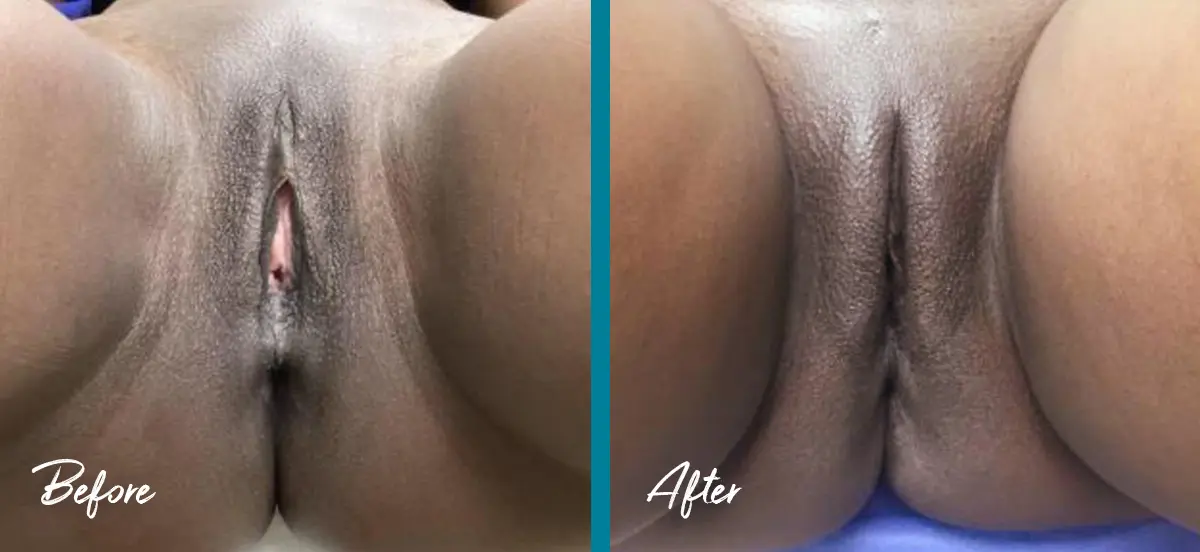 Labial puffing before and after photo showing fat transfer to restore volume to the labia majora in a 47-year-old patient