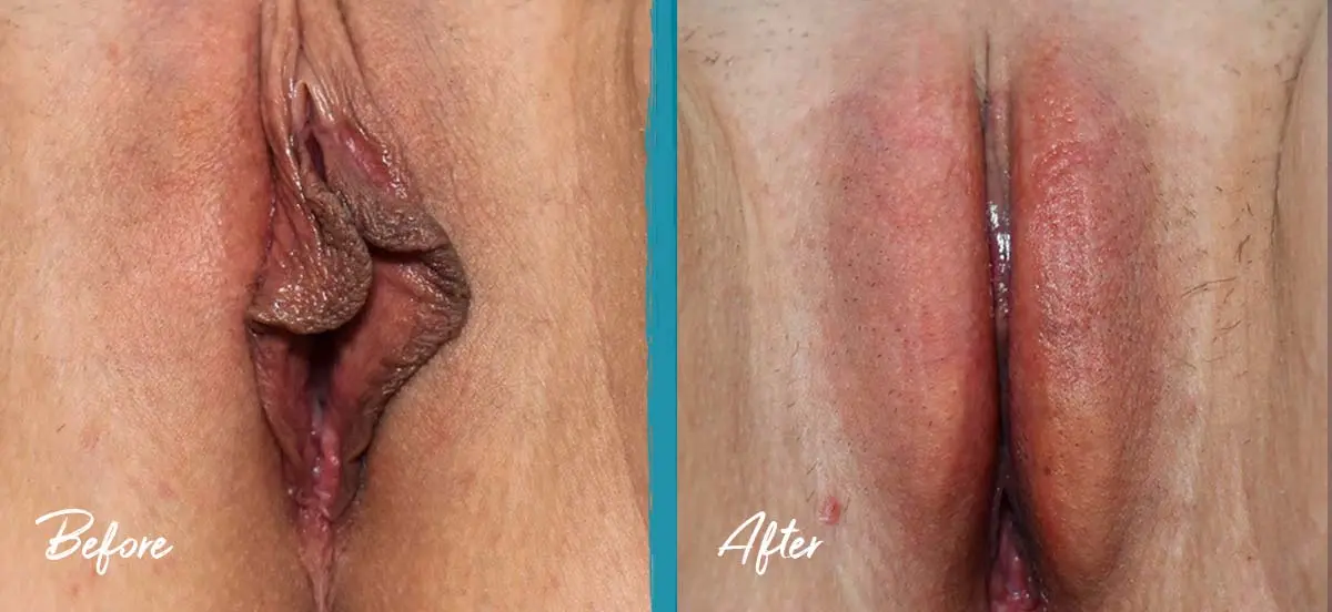 Labial puffing before and after photo of labiaplasty, clitoral hood reduction, and fat transfer in a 25-year-old patient