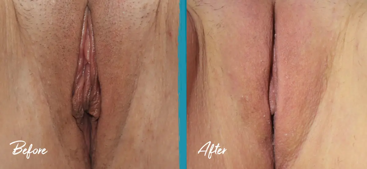 Labial puff images of labiaplasty, clitoral hood reduction, and conservative fat transfer to the labia majora