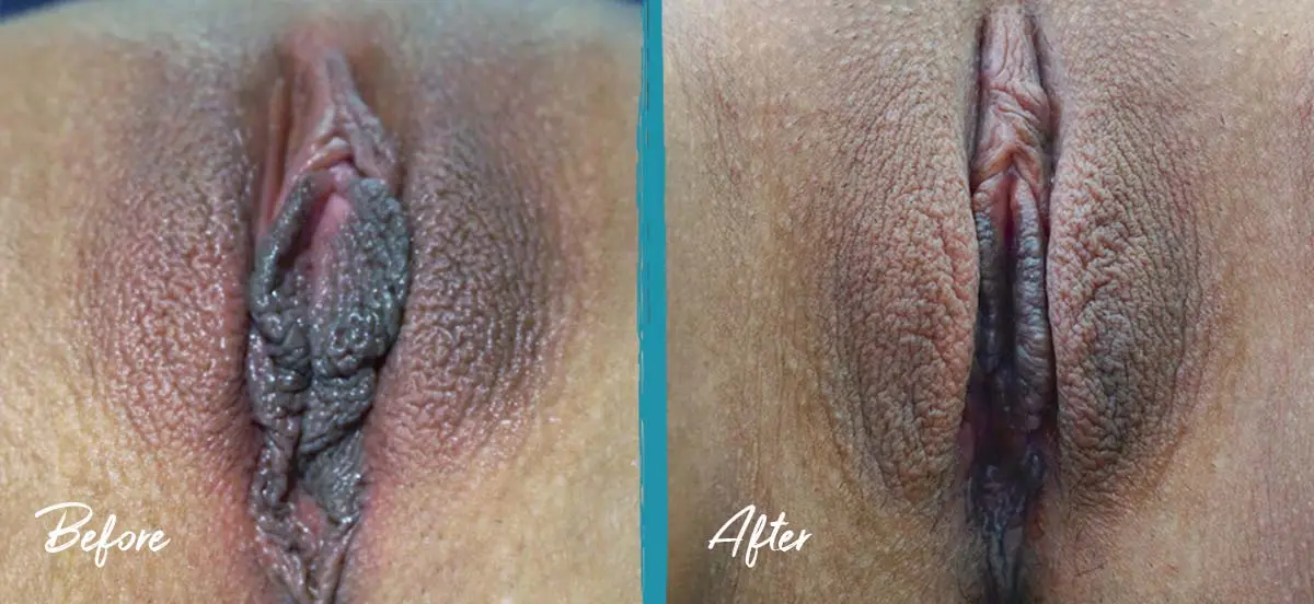 Labia puffing pictures of labiaplasty, clitoral hood reduction, and fat transfer for self-perceived labial hypertrophy
