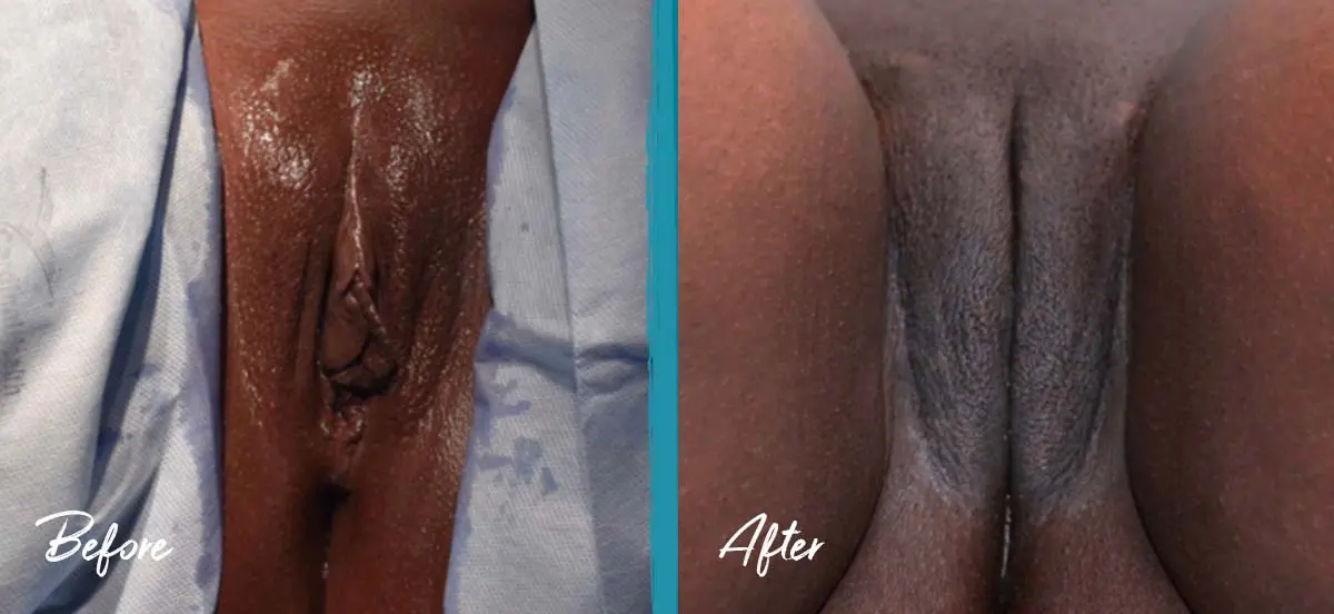 Labial puff before and after photo of labiaplasty, clitoral hood reduction, and fat transfer to the labia majora, NYC patient