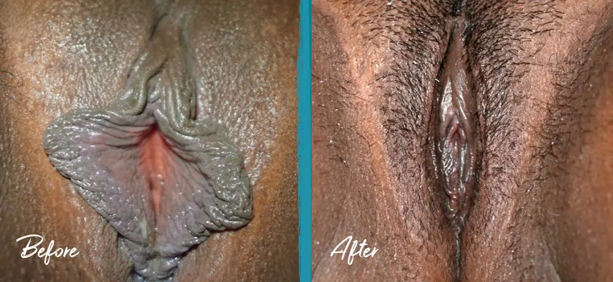 Labia puffing pictures of labiaplasty, clitoral hood reduction, and fat transfer for chronic labial discomfort