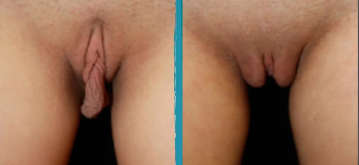 Labial puffing before and after photo of minimally invasive labiaplasty, clitoral hood reduction, and fat transfer to the labia majora