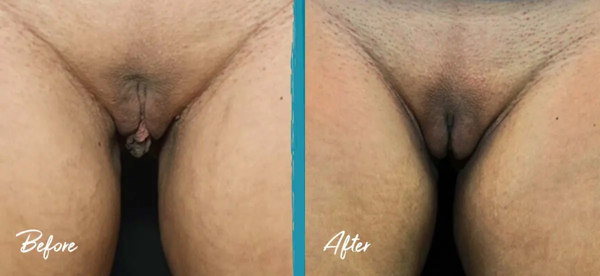 Labia puffing pictures showing labiaplasty, clitoral hood reduction, and fat transfer for irritation during exercise