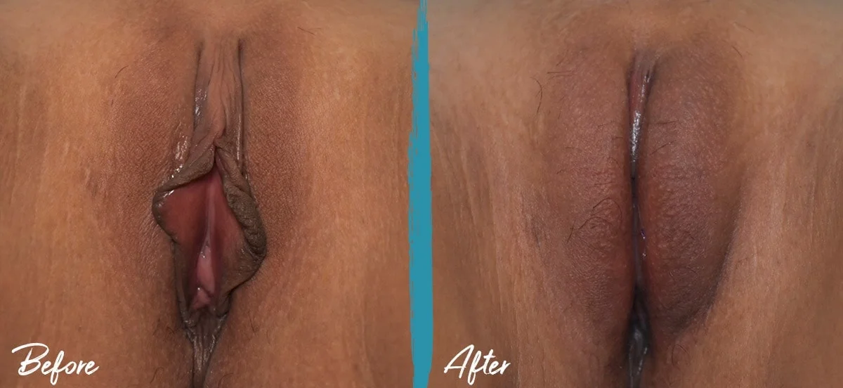 Labia puffing pictures of labiaplasty, clitoral hood reduction, and fat transfer to the labia majora after childbirth, before and after