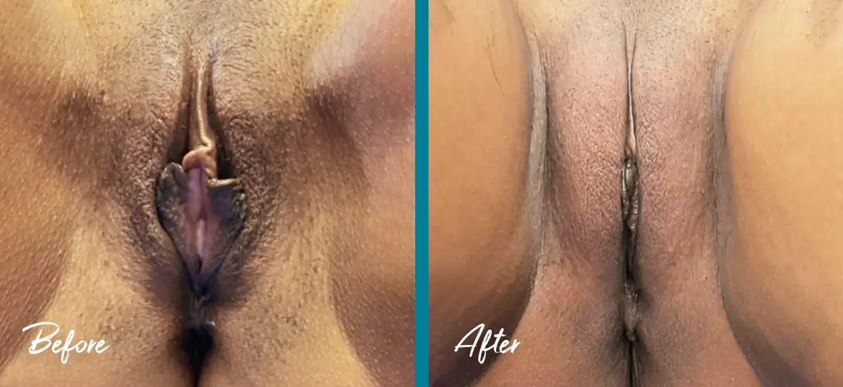 Labial puff before and after photo of labiaplasty, clitoral hood reduction, and fat transfer to the labia majora at Labiaplasty NYC