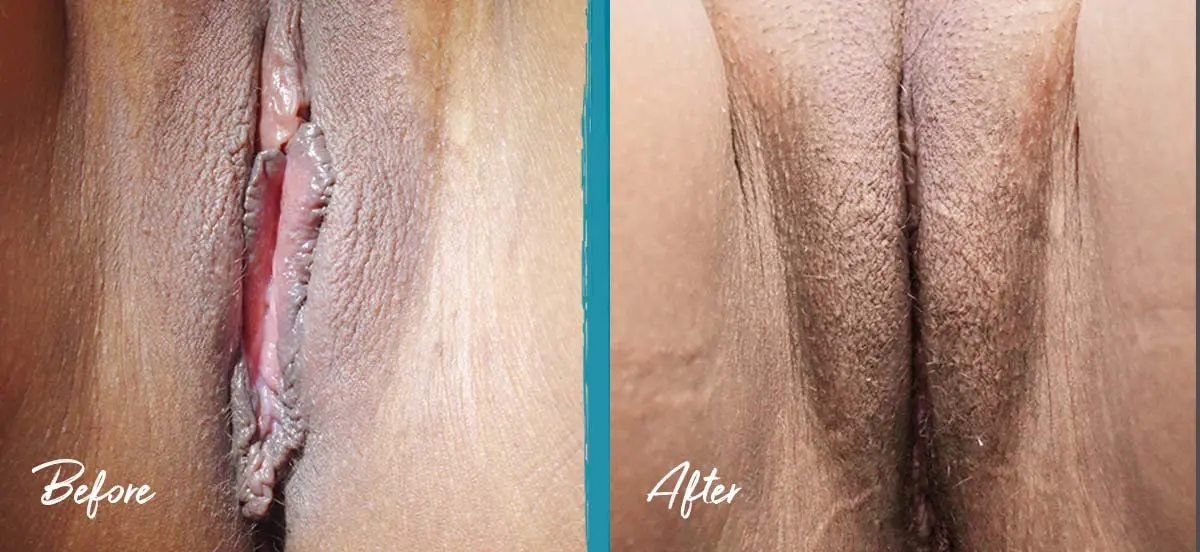 Labia puffing photos of revision labiaplasty with clitoral hood reduction and fat transfer to the labia majora