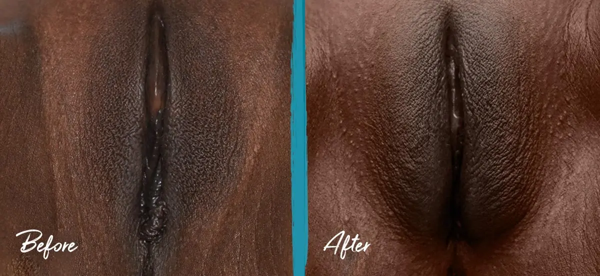 Labial puff images showing perineal scar removal, perineoplasty, vaginoplasty, and fat transfer to the labia majora, before and after