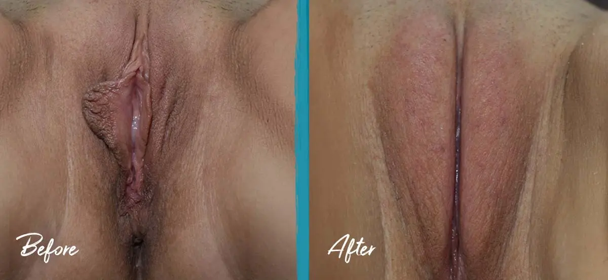 Labial puffing before and after photo showing fat transfer to the labia majora combined with vaginoplasty, labiaplasty, perineoplasty, and clitoral hood reduction, 5 weeks post-op