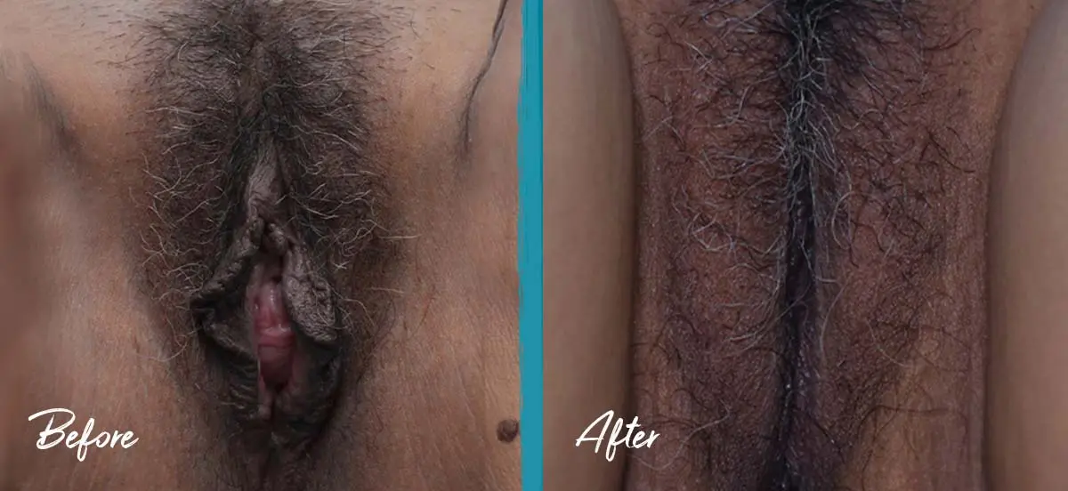 Labial puffing before and after photo of vaginoplasty, perineoplasty, labiaplasty, and fat transfer in a mother of three